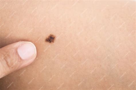 birthmark on penis|Birthmark on Private Part Meaning